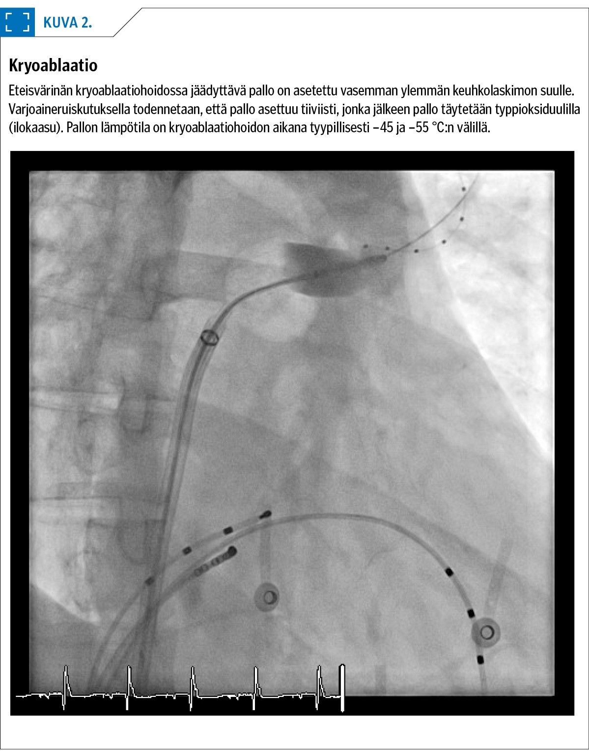 Lääkärilehti - Eteisvärinän katetriablaatiohoito