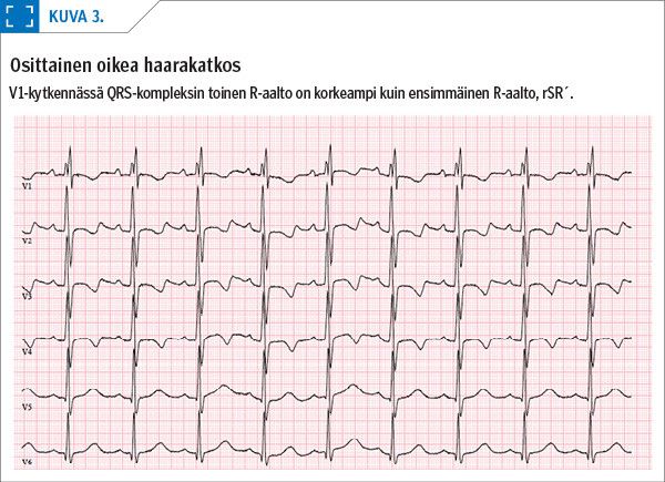 Osittainen oikea haarakatkos