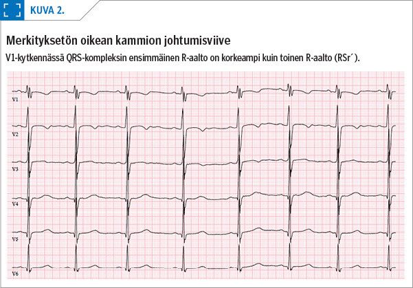 Merkityksetön oikean kammion johtumisviive