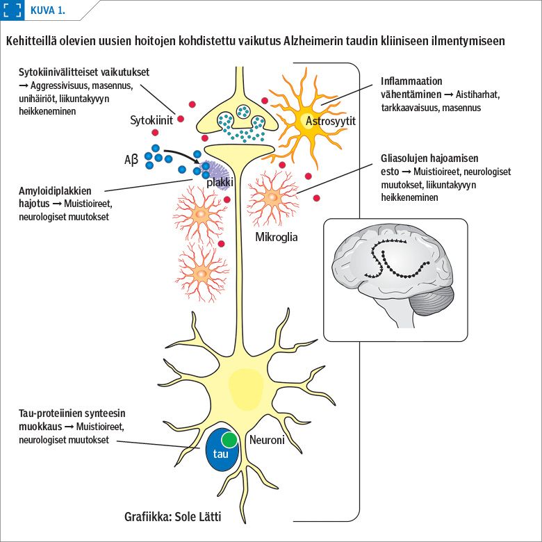 Laakarilehti Missa Viipyvat Alzheimerin Taudin Uudet Laakkeet